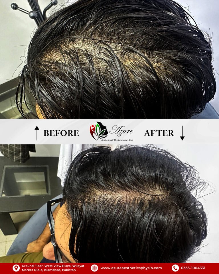 Before-After