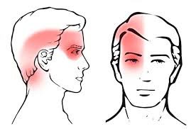 Cervicogenic Headaches