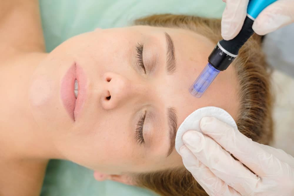 Microneedling Treatments